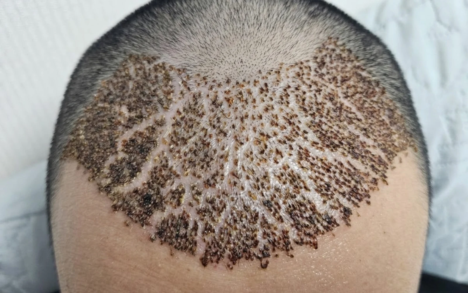 Cracks after hair transplant