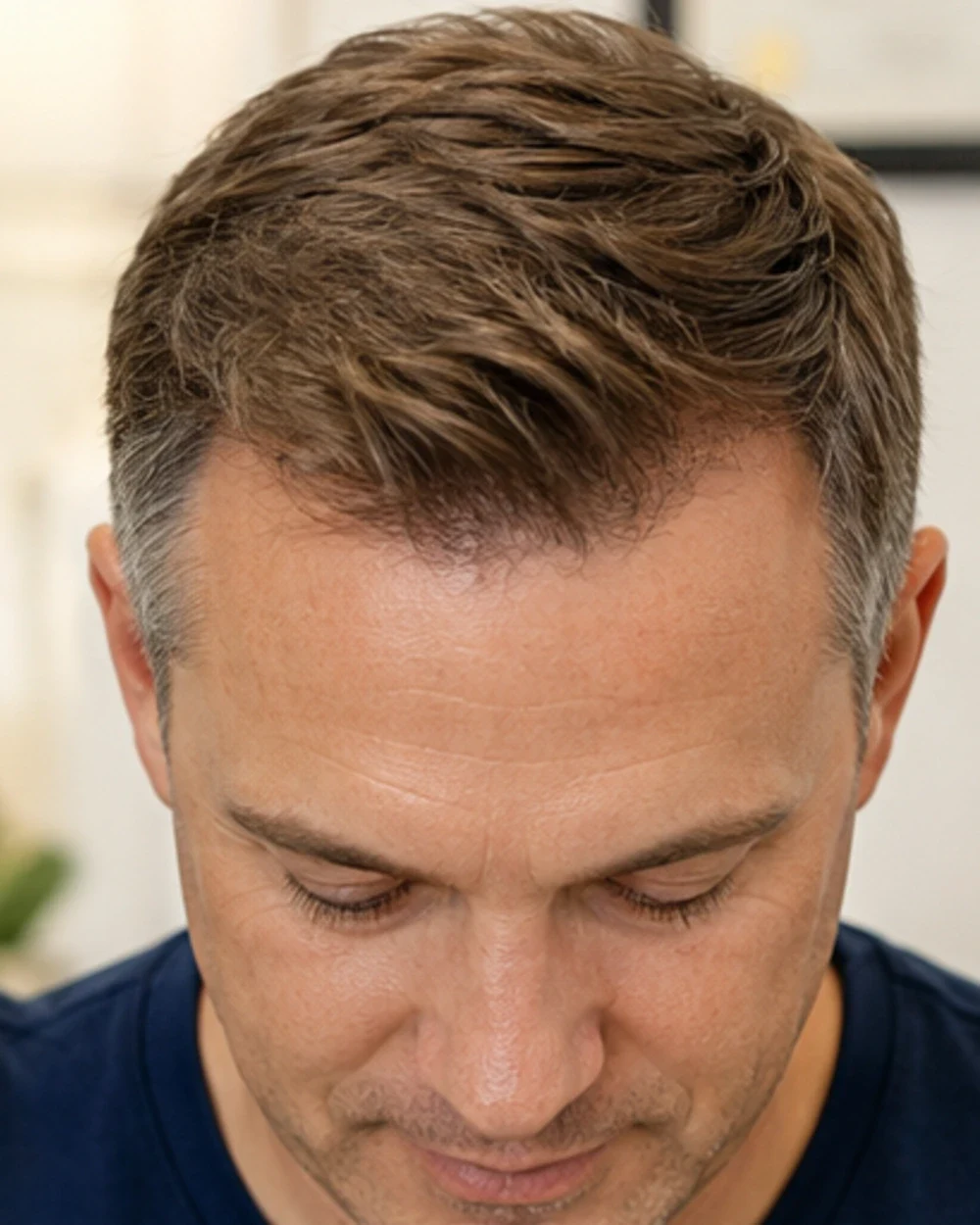Frontal Hairline Restoration — after