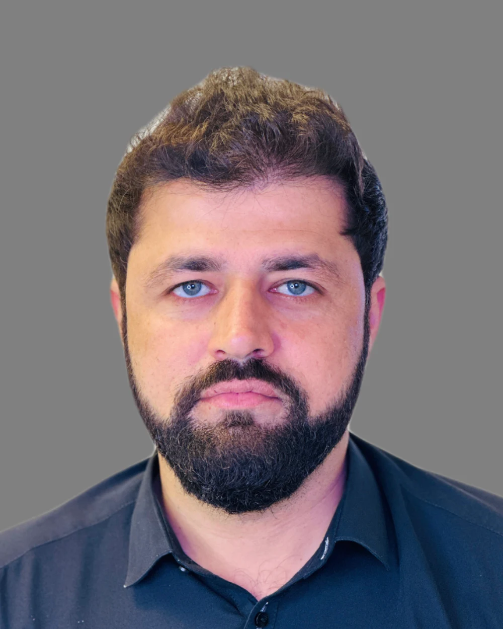 Hair Transplant — after