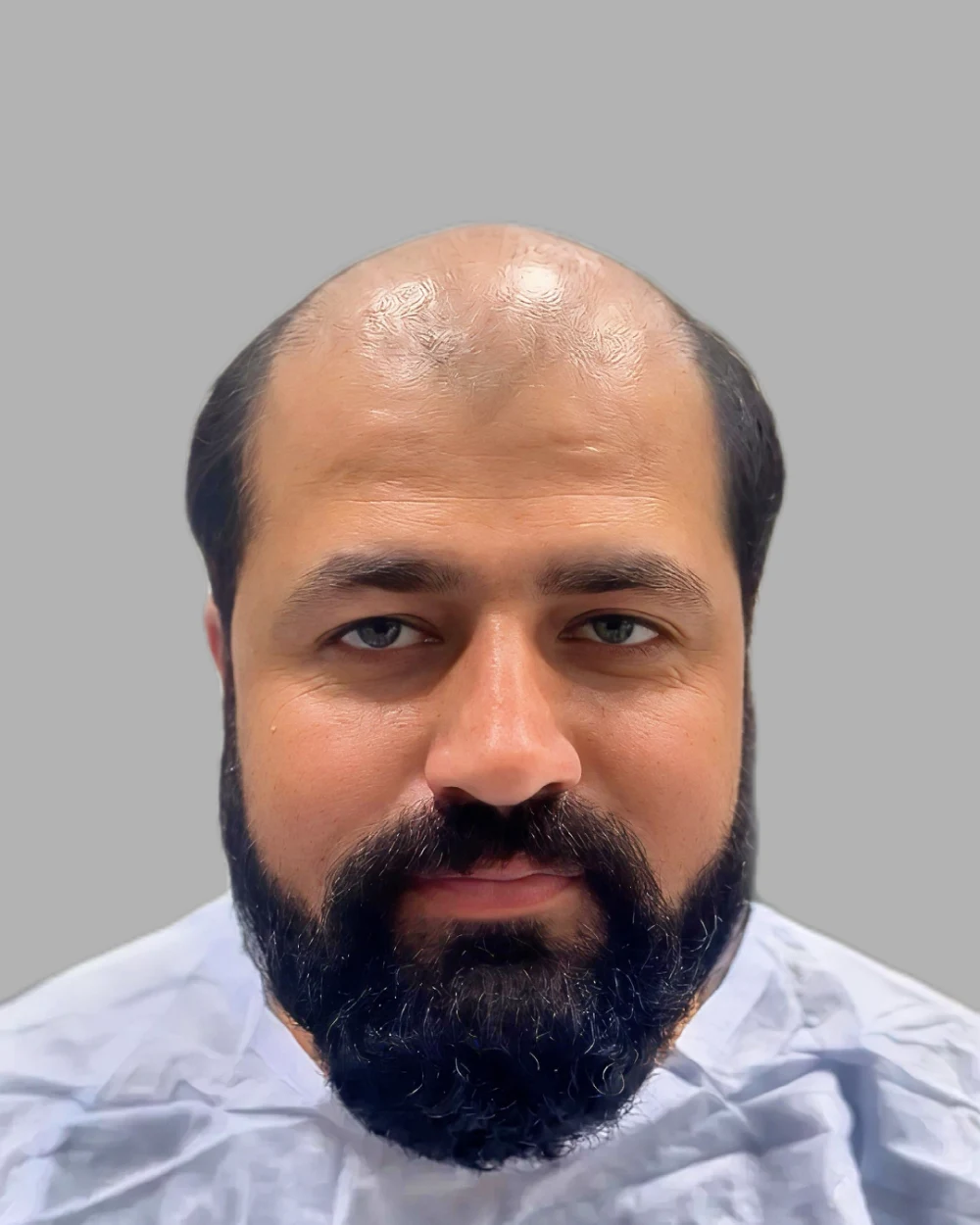 Hair Transplant — before